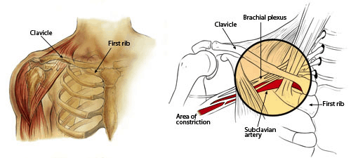 Thoracic Outlet Syndrome (TOS) and other similar conditions - Back